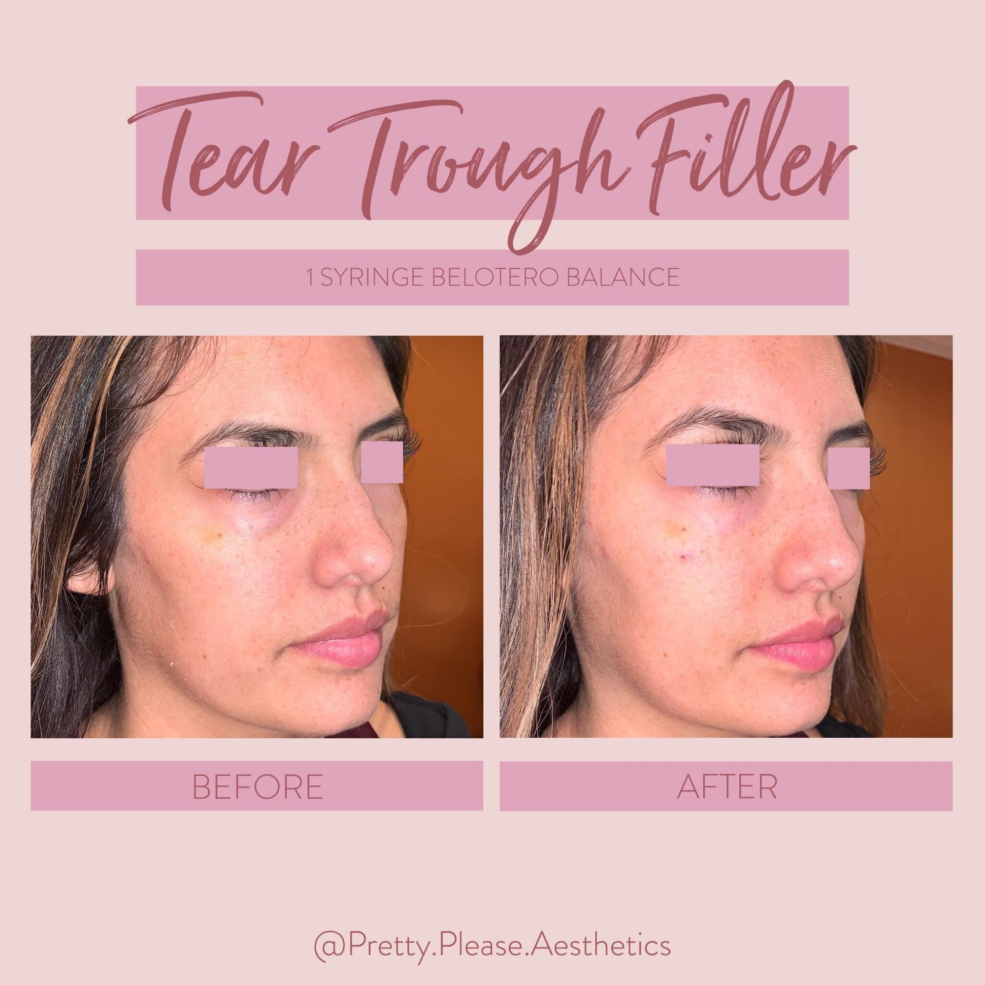 Sacramento dermal fillers before-and-afters
