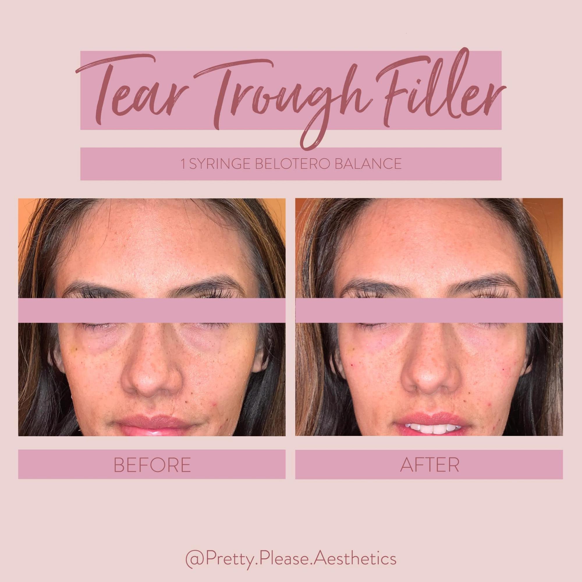 Sacramento dermal fillers before-and-afters