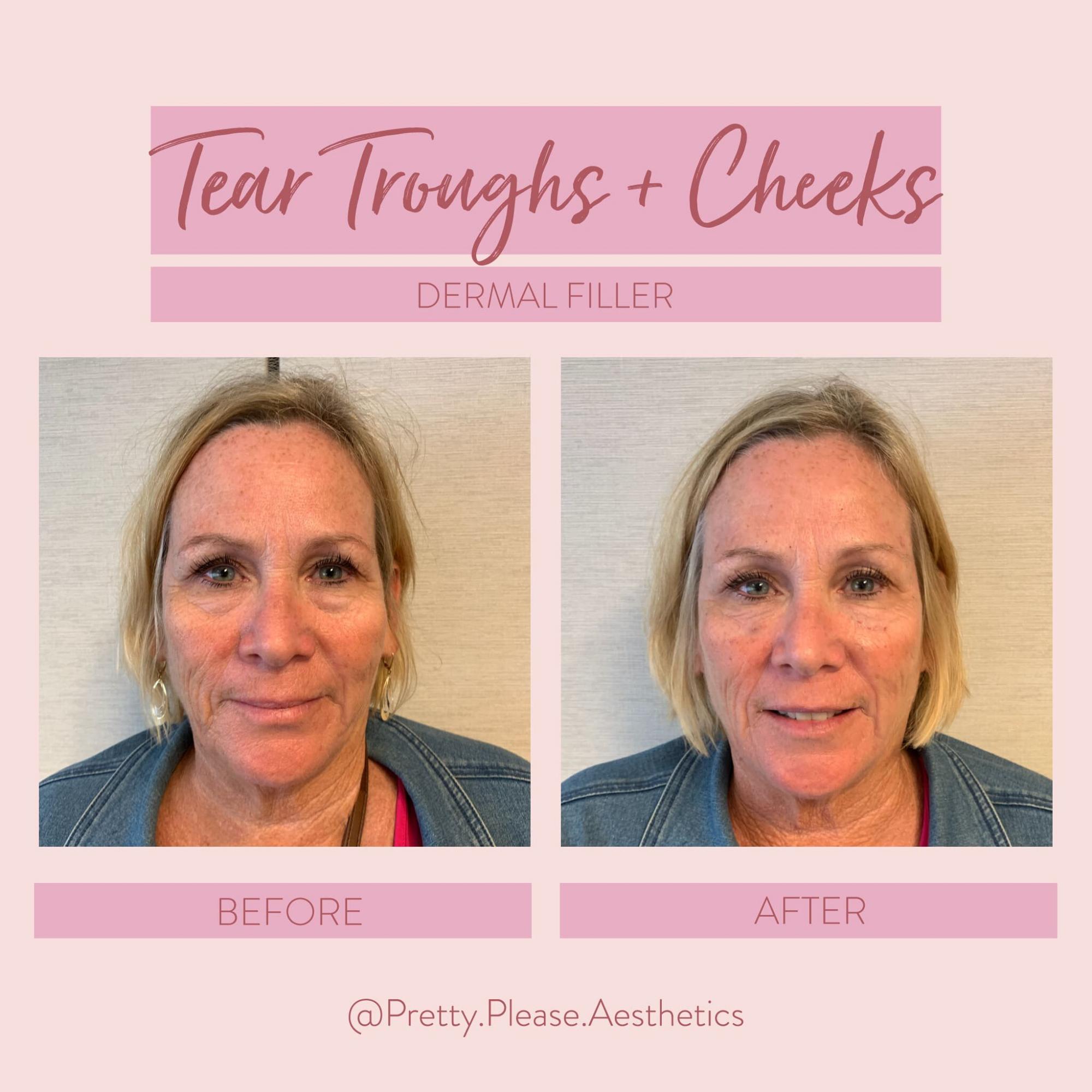 Sacramento dermal fillers before-and-afters