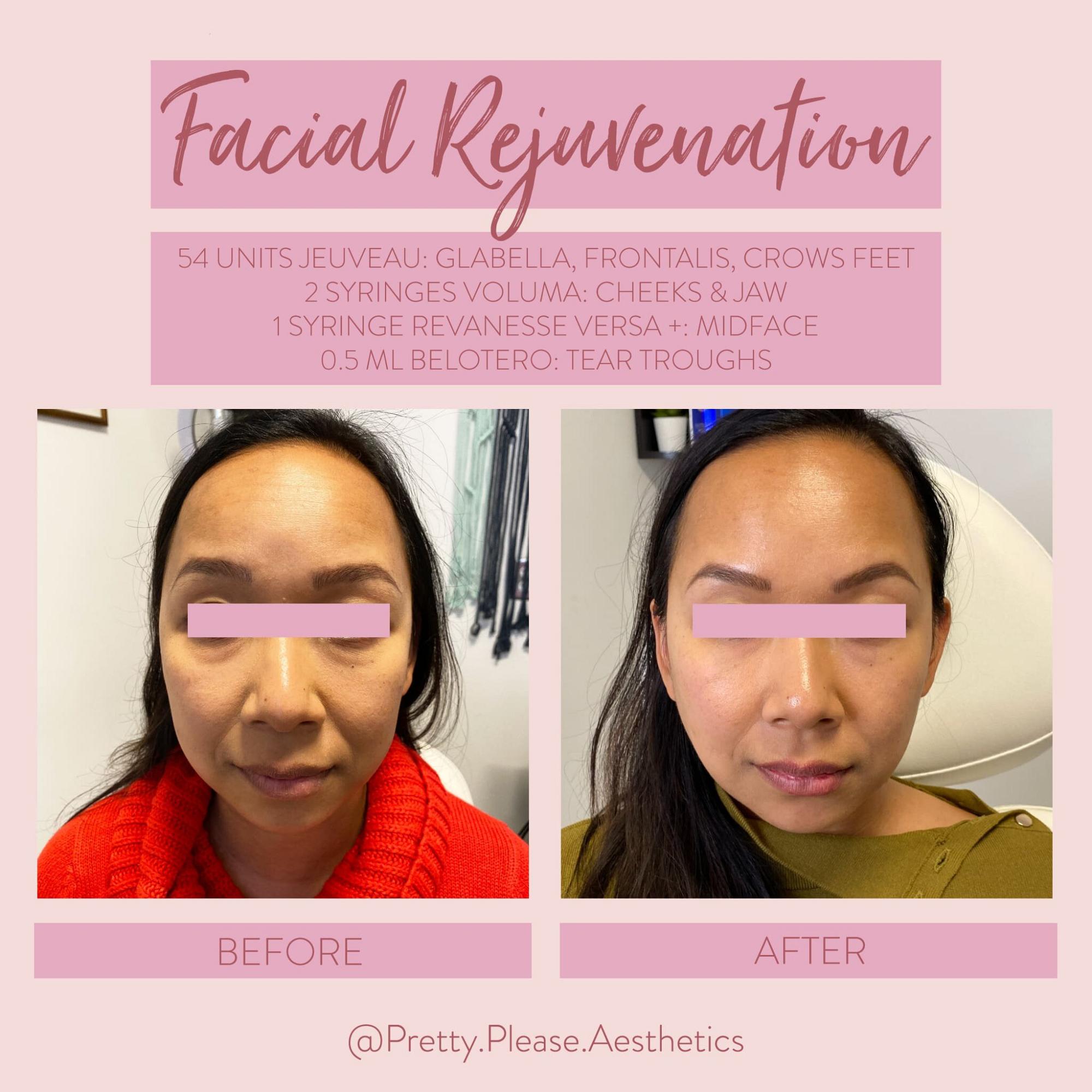 Sacramento dermal fillers before-and-afters