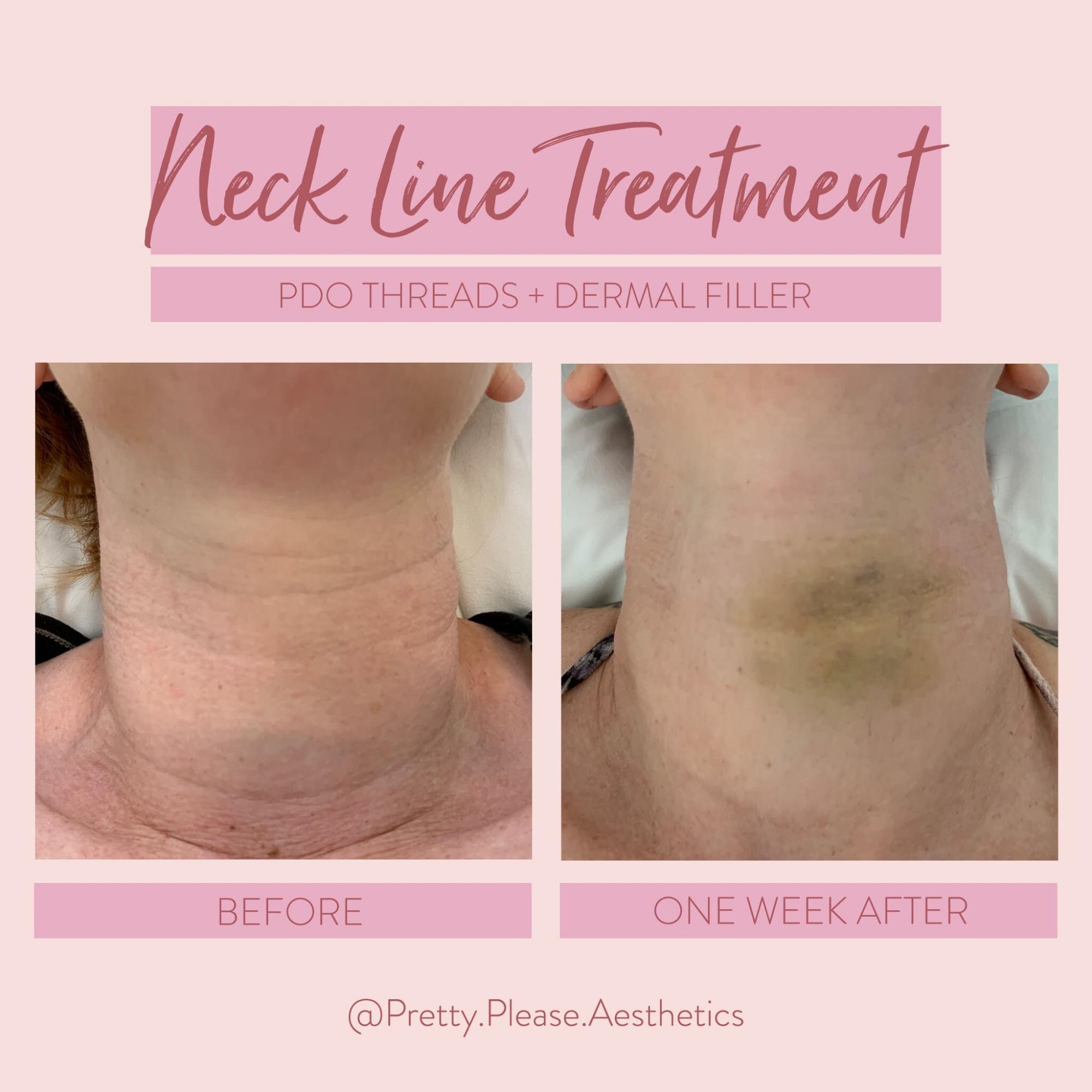 Sacramento dermal fillers before-and-afters