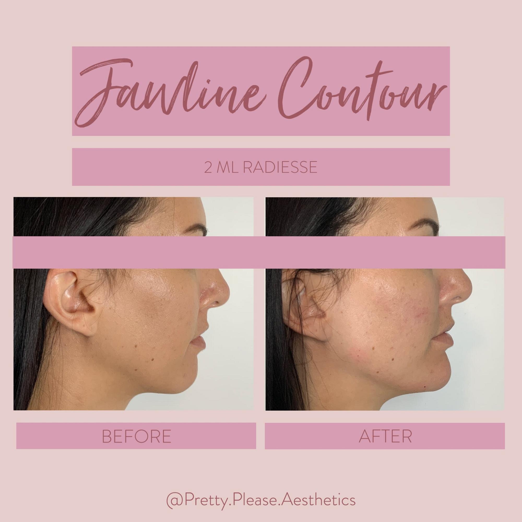Sacramento dermal fillers before-and-afters