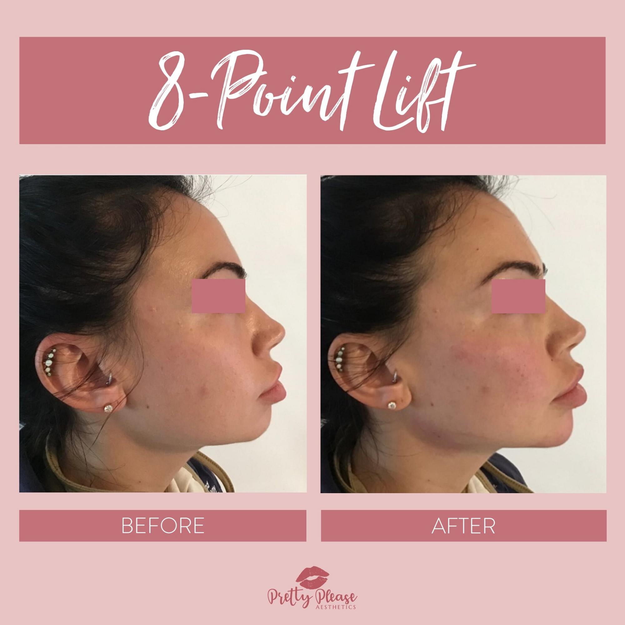 Sacramento dermal fillers before-and-afters