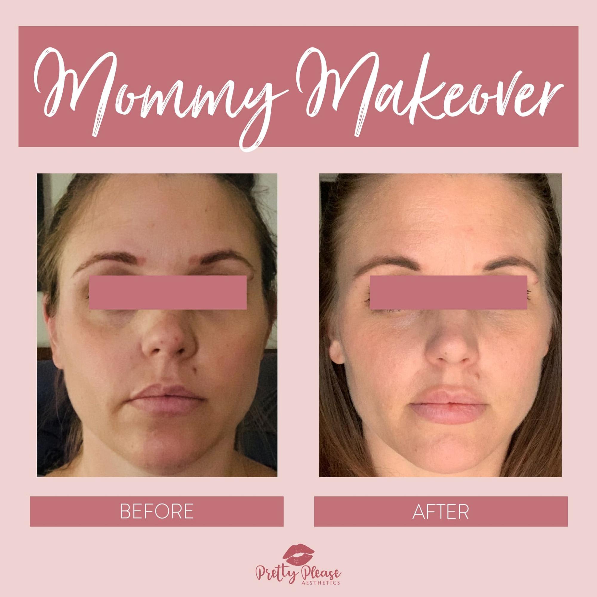 Sacramento dermal fillers before-and-afters