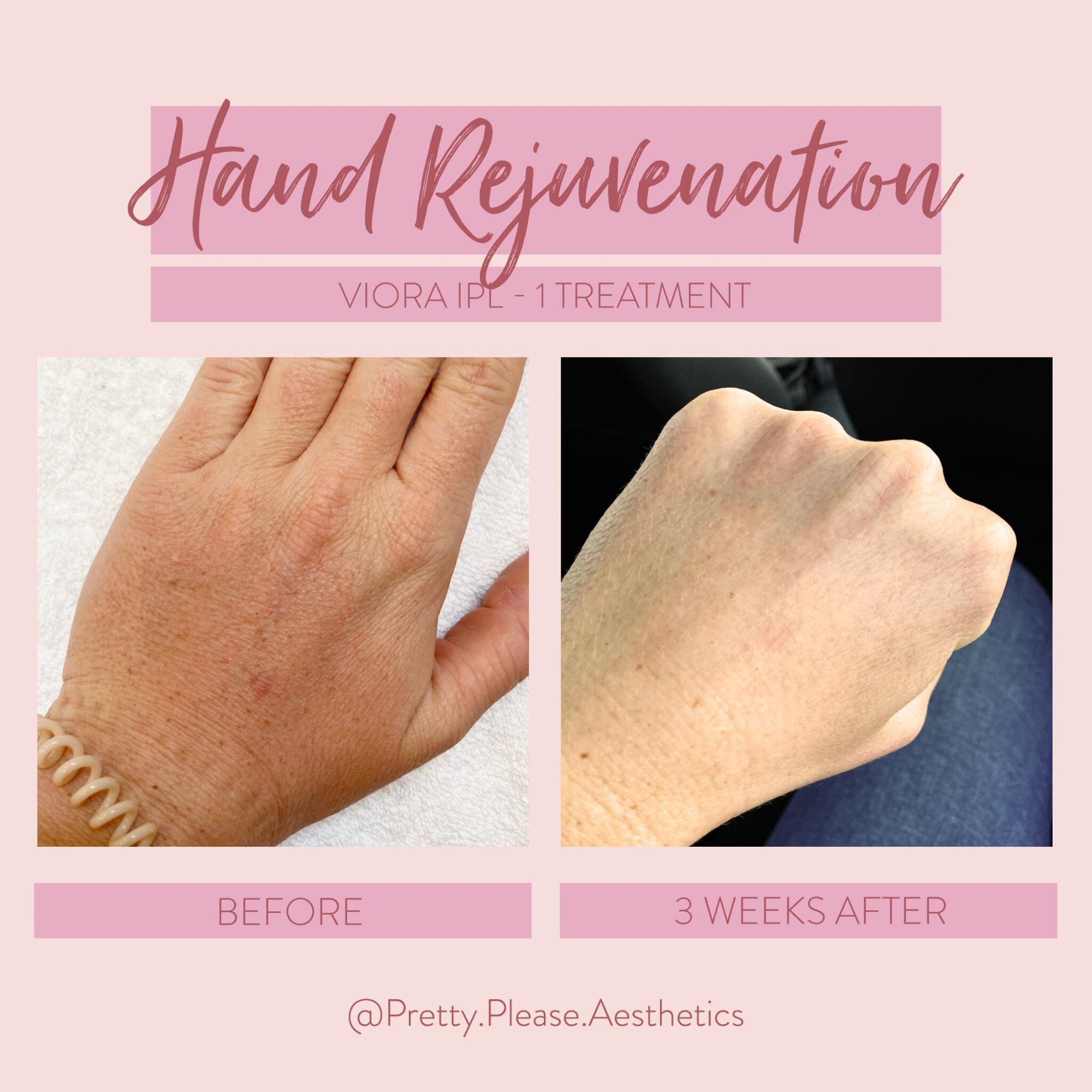 Sacramento IPL treatment