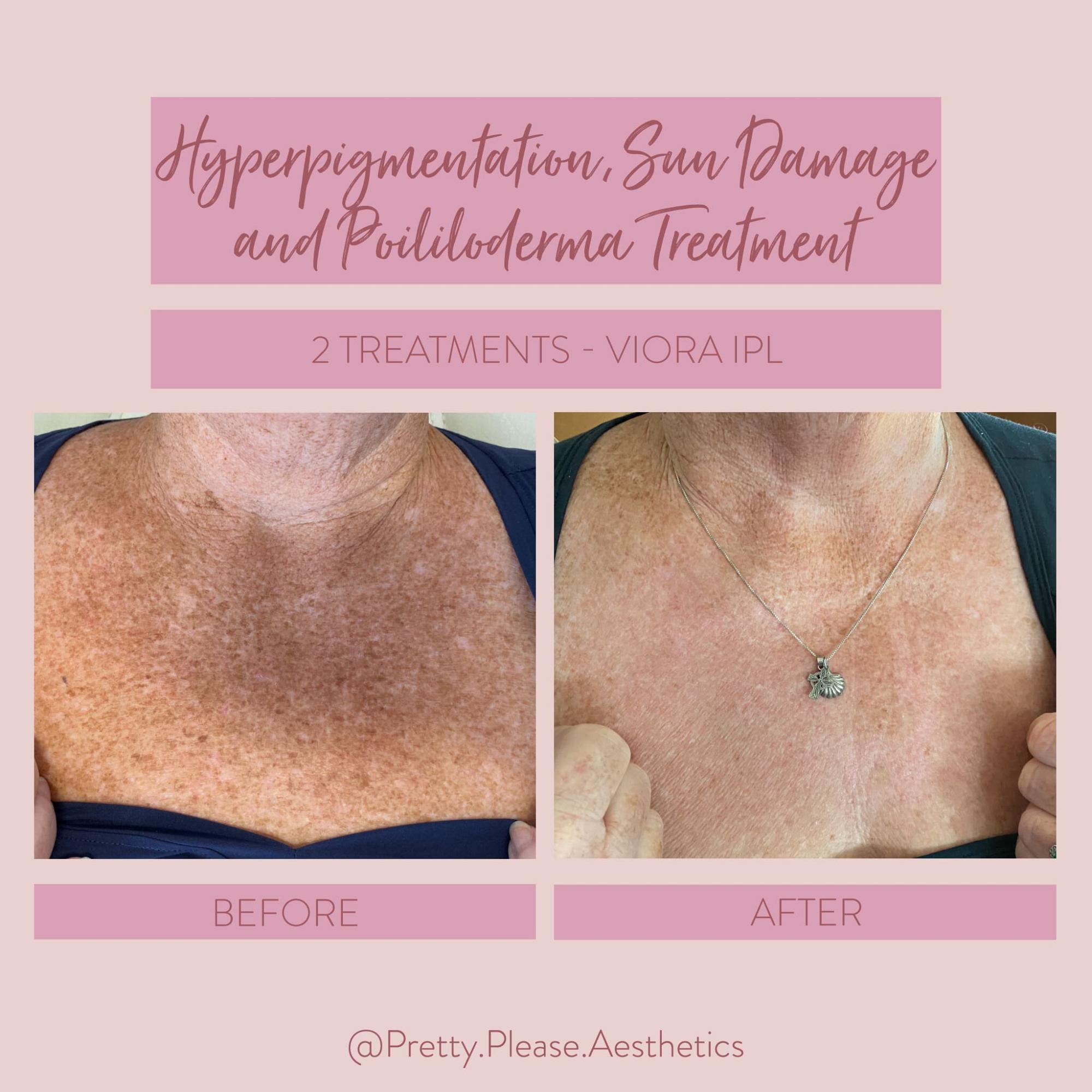 Sacramento IPL treatment
