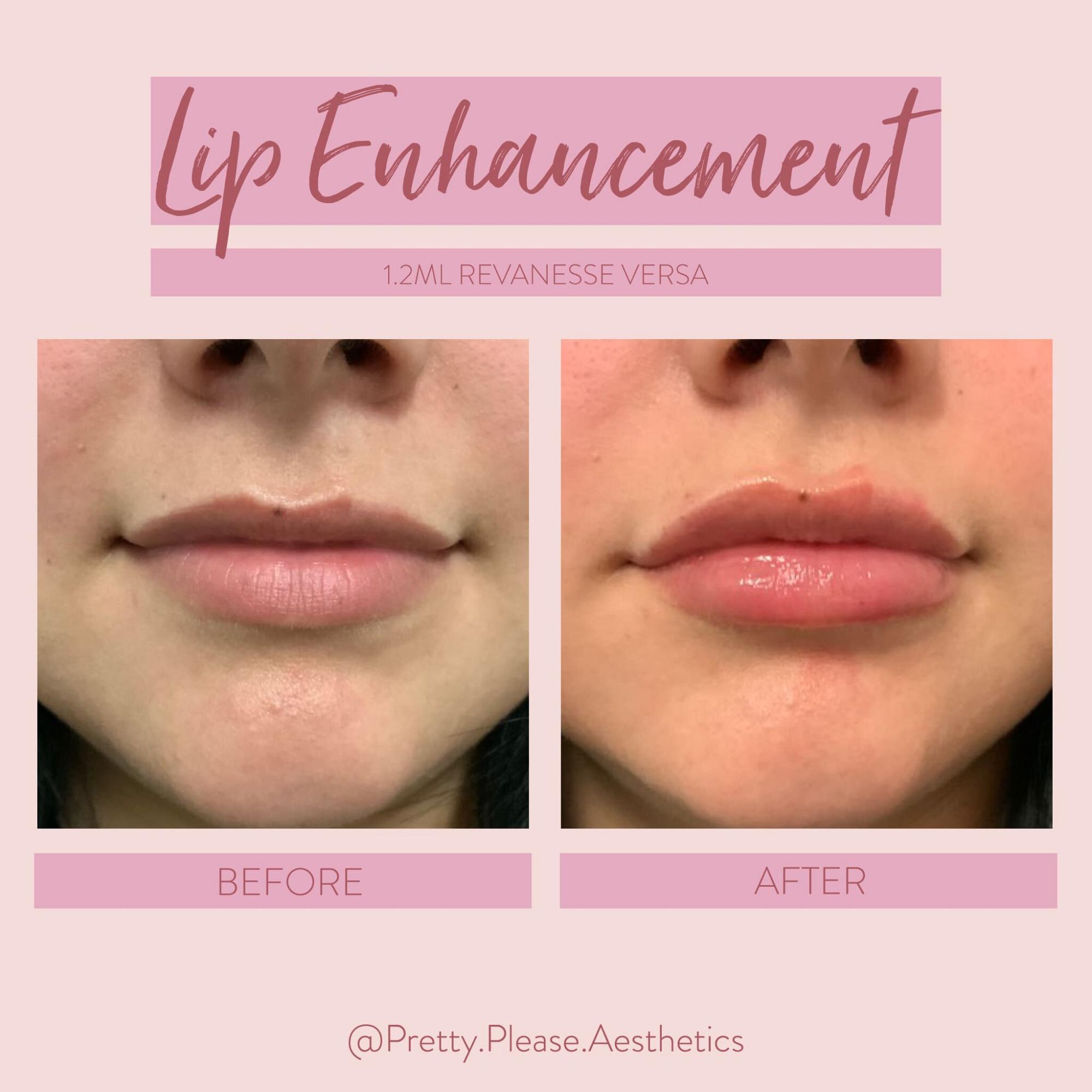 Sacramento lip enhancement before-and-afters