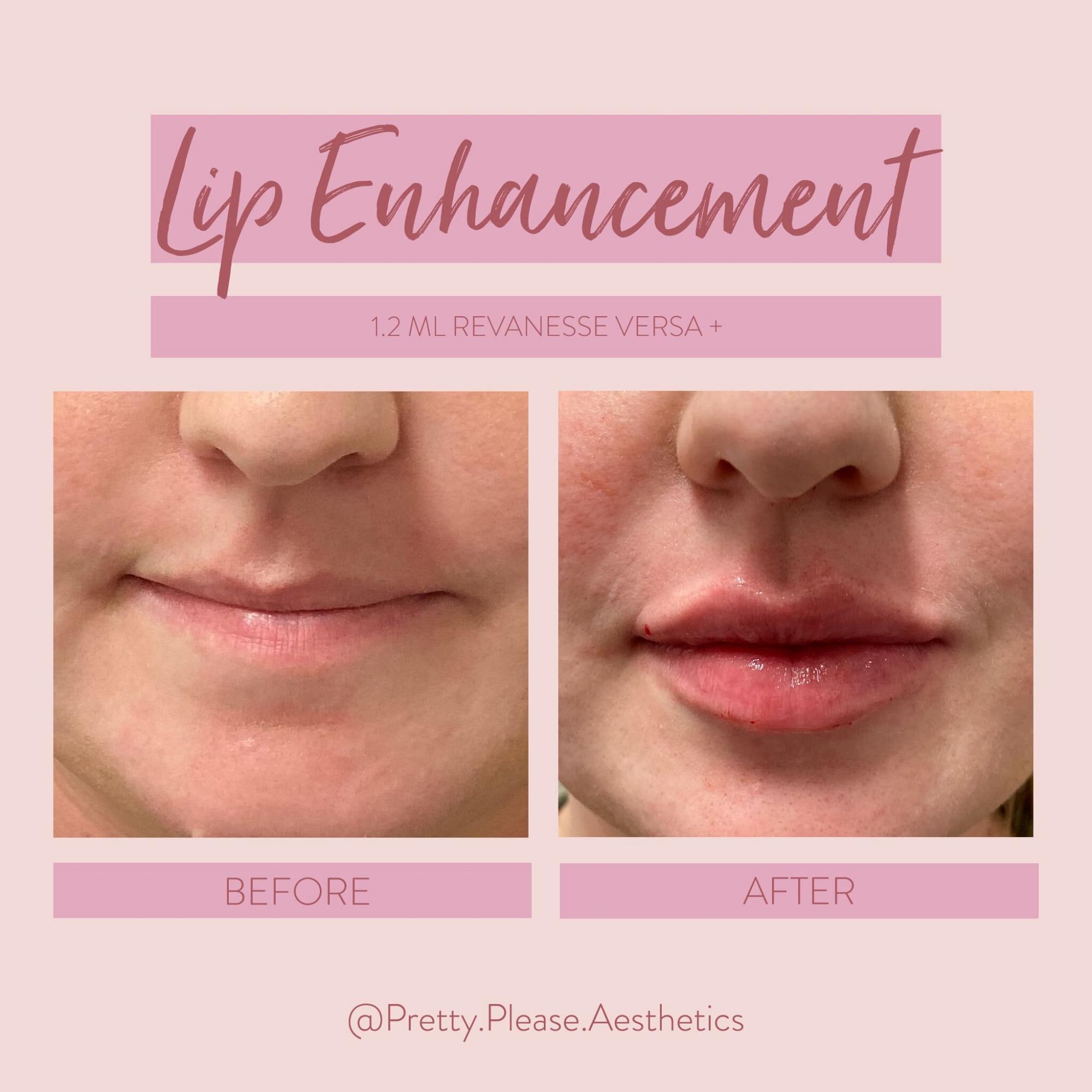 Sacramento lip enhancement before-and-afters