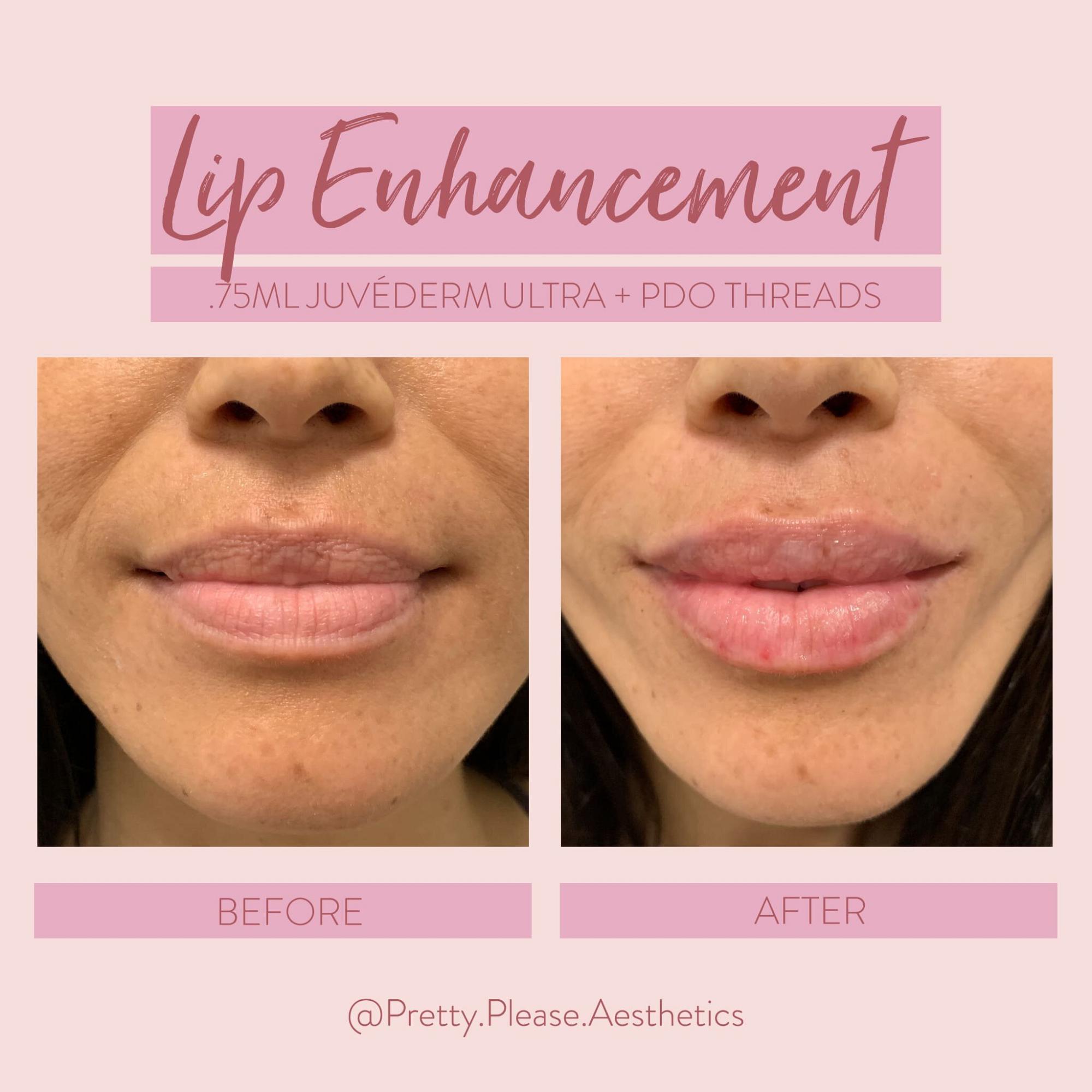 Sacramento lip enhancement before-and-afters