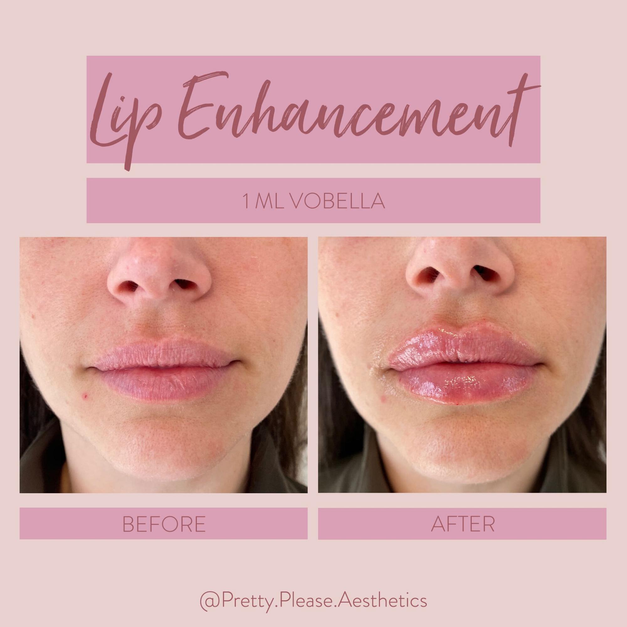 Sacramento lip enhancement before-and-afters