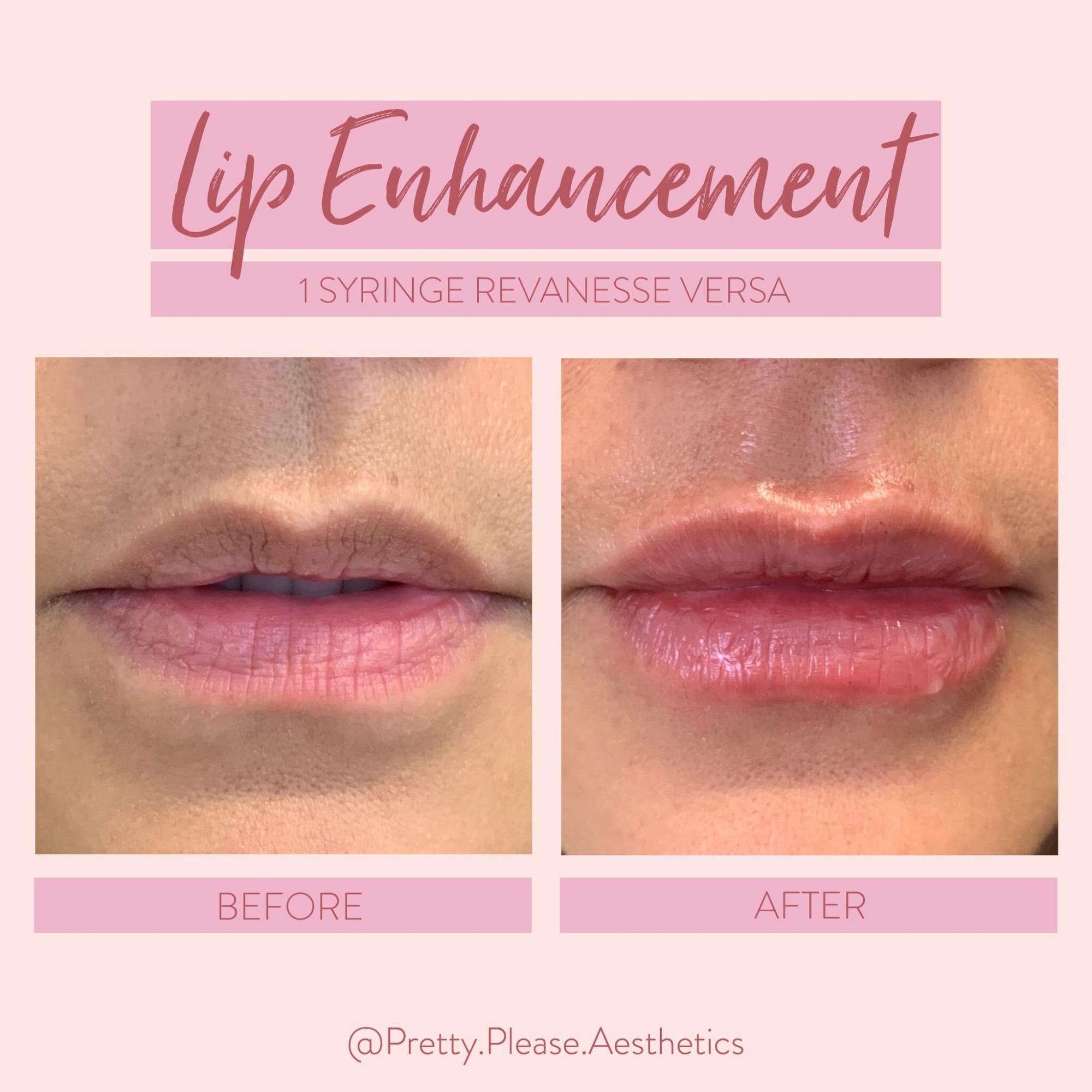 Sacramento lip enhancement before-and-afters