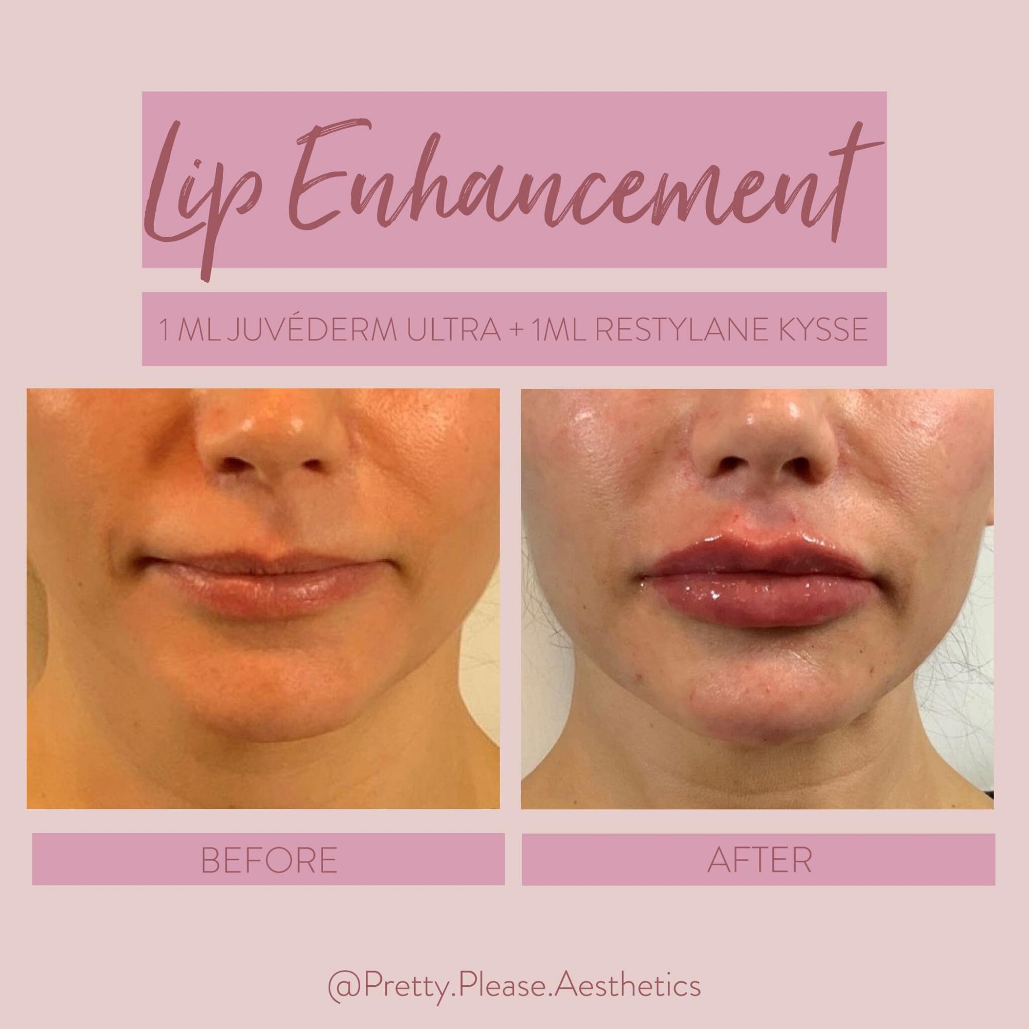Sacramento lip enhancement before-and-afters