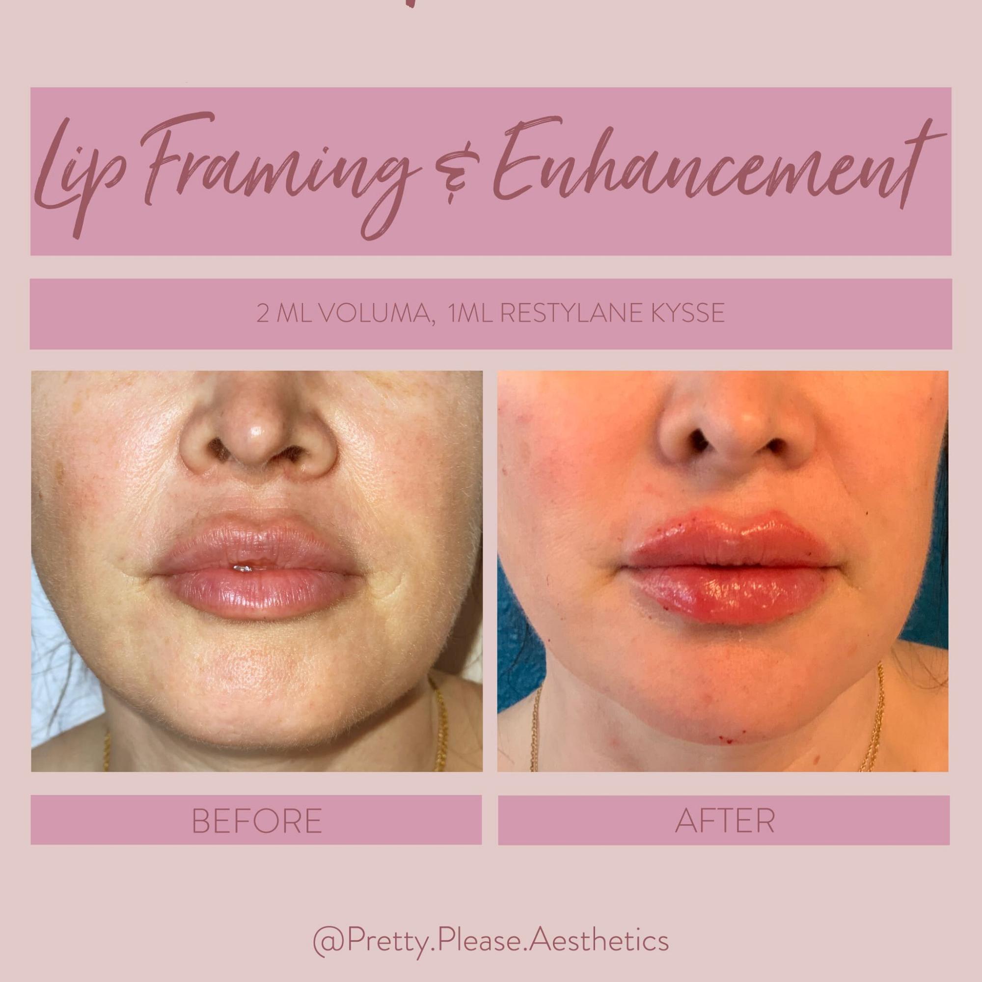 Sacramento lip enhancement before-and-afters