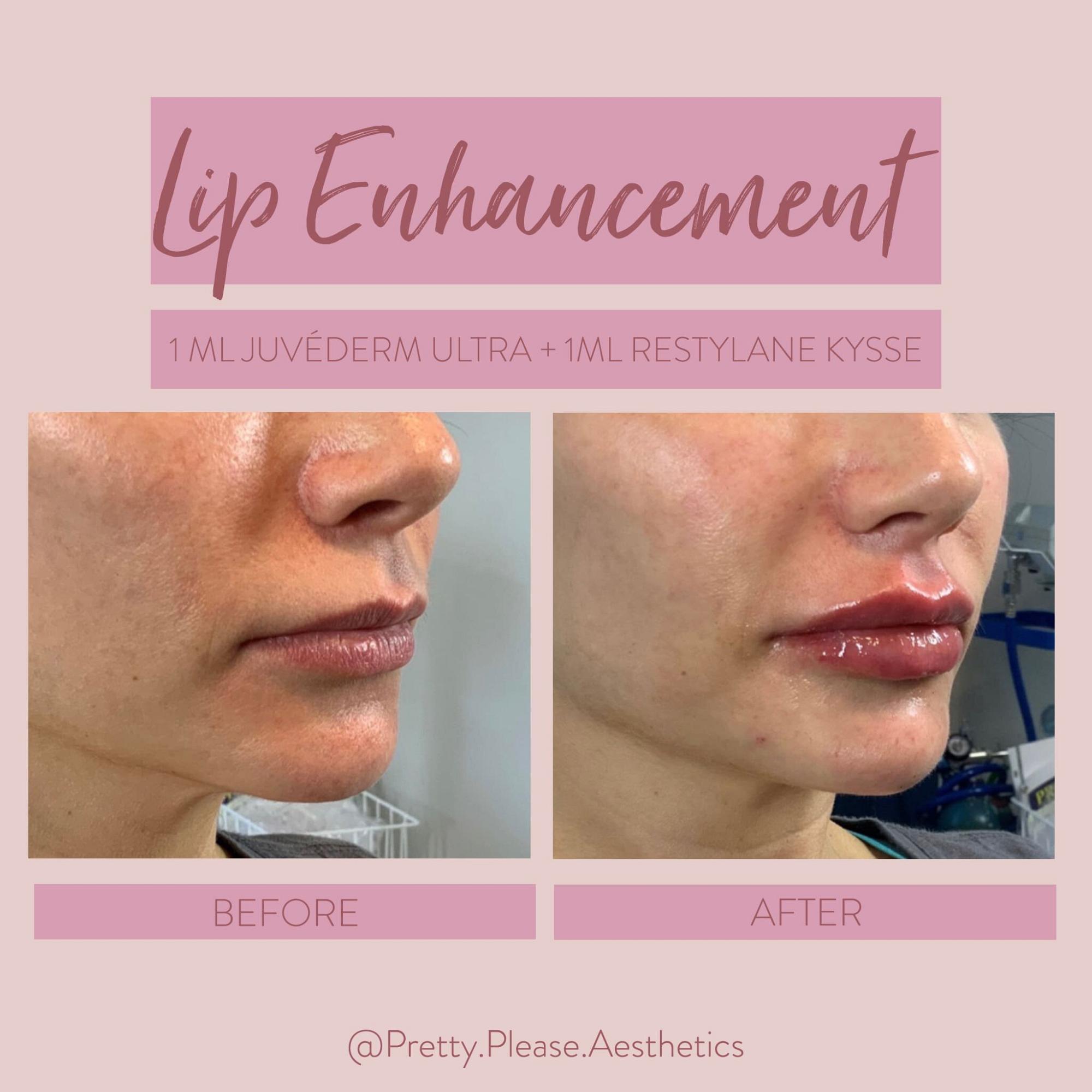 Sacramento lip enhancement before-and-afters