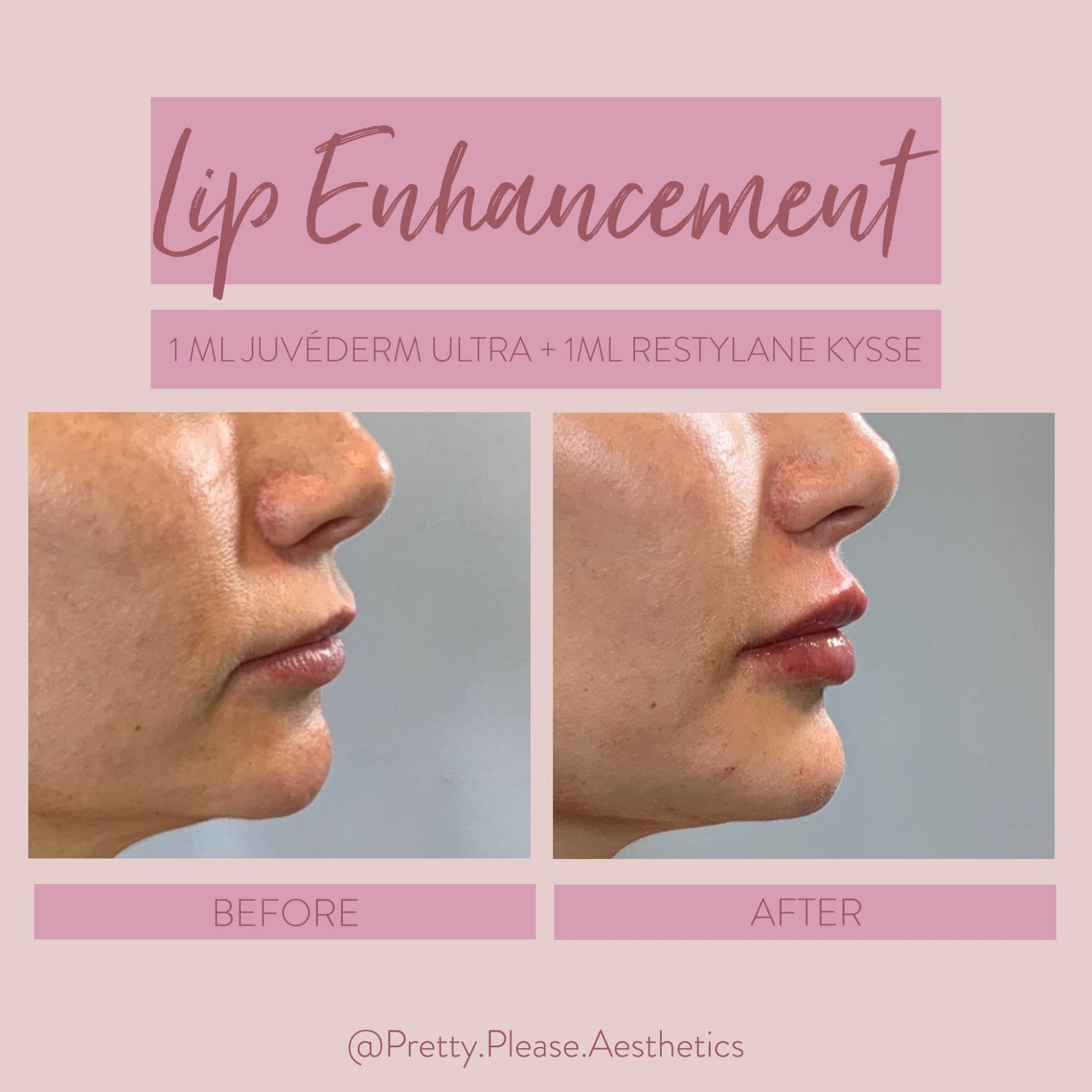 Sacramento lip enhancement before-and-afters