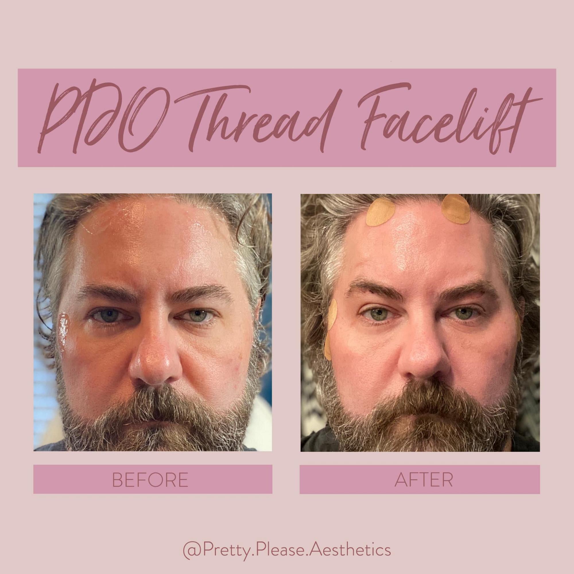 Sacramento PDO Thread before-and-after