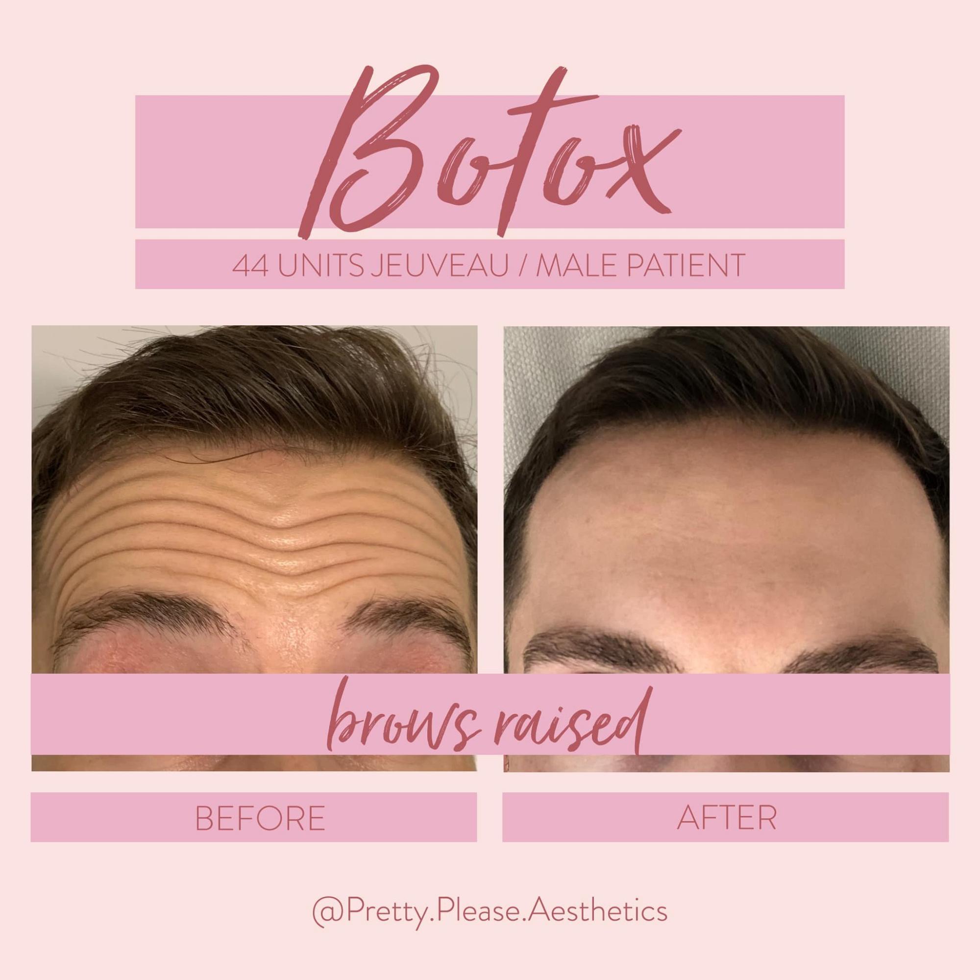 Sacramento Botox before-and-afters