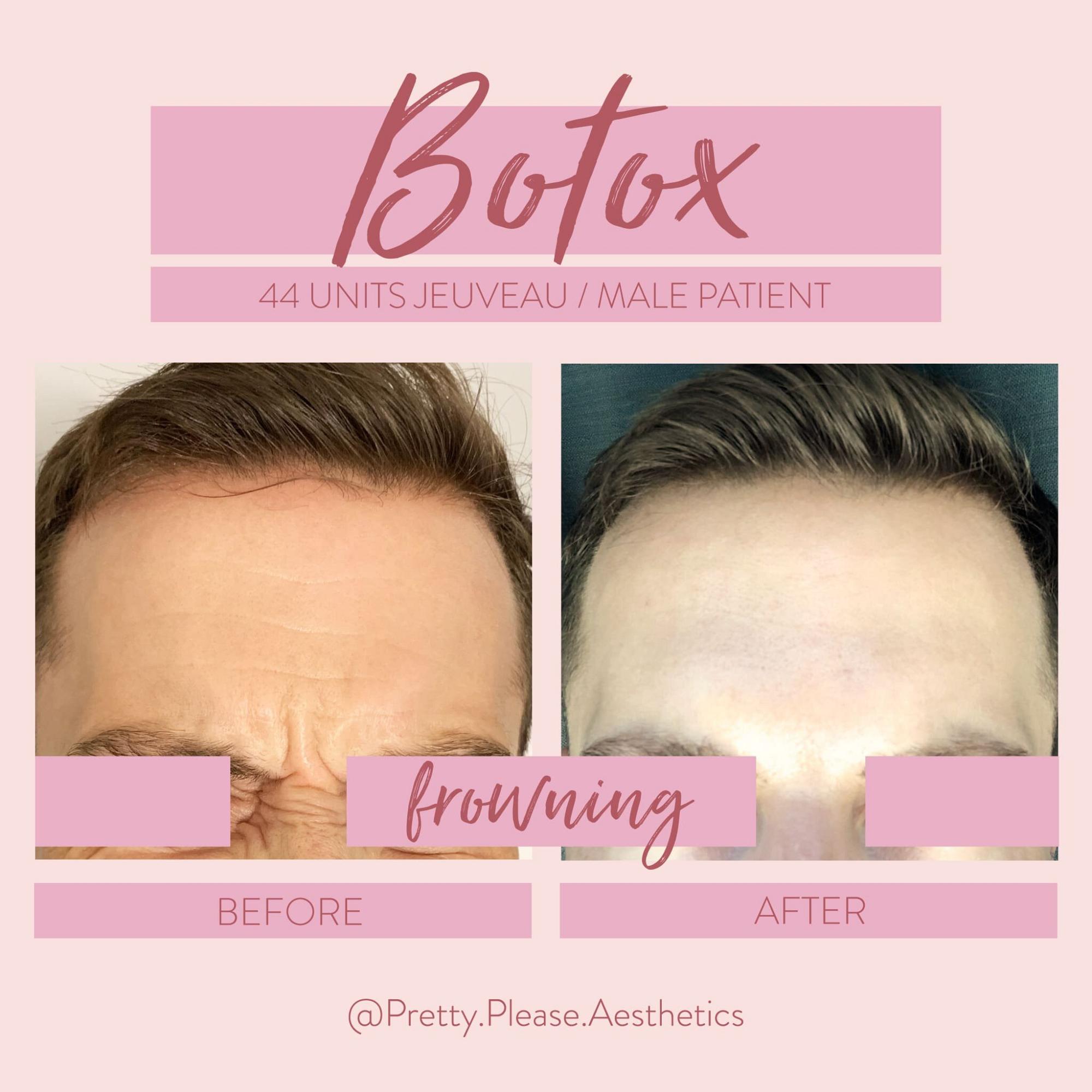Sacramento Botox before-and-afters