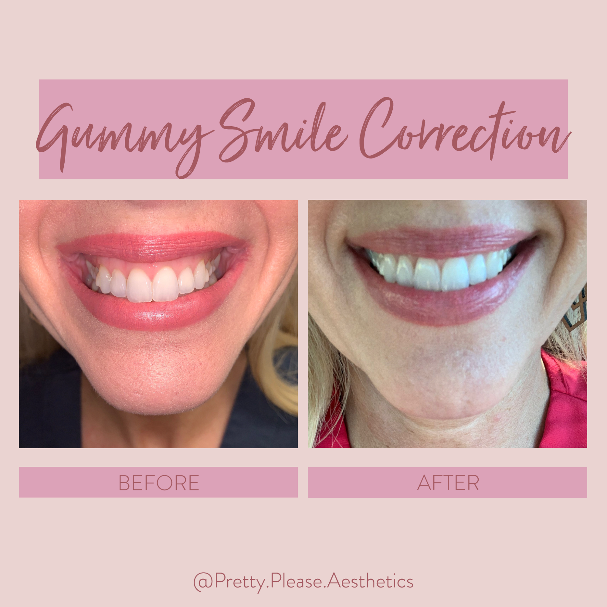 Smile correction before-and-afters