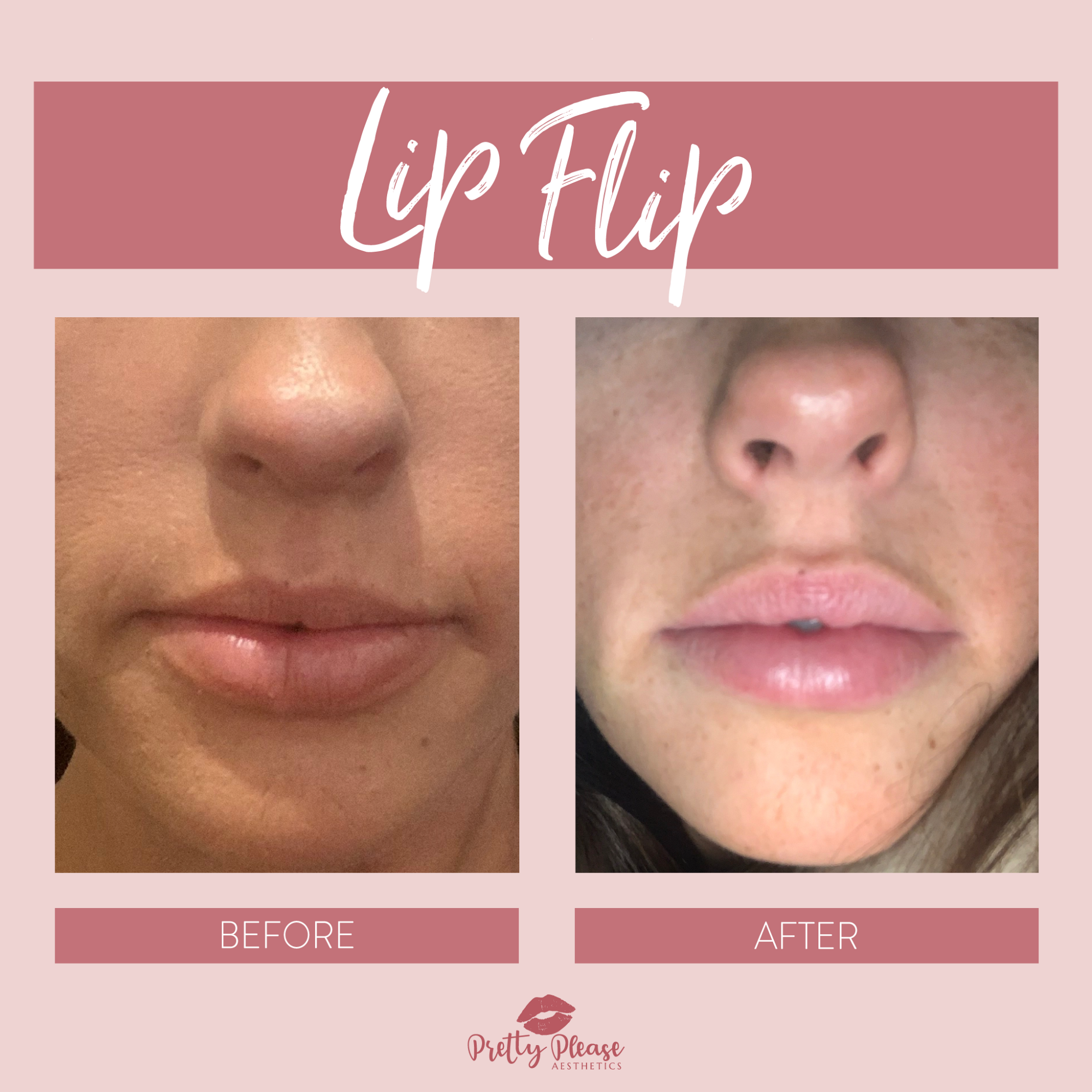 Sacramento lip flip before-and-afters