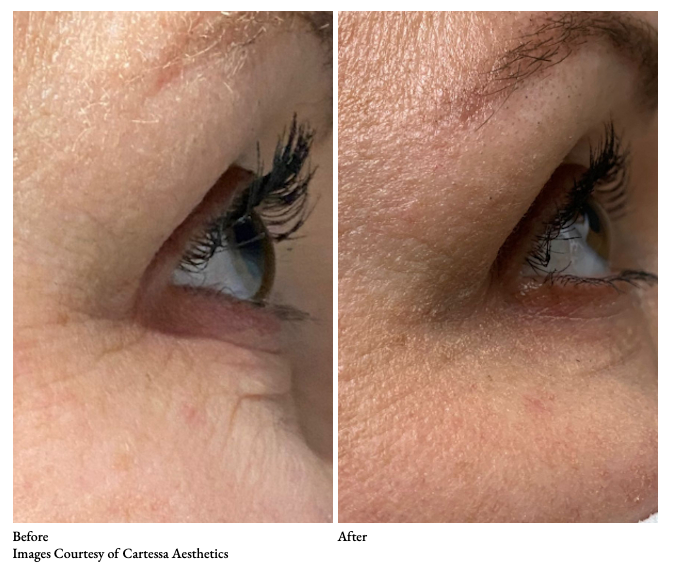 Subnovii Plasma Pen Under Eye Skin Tightening Sacramento