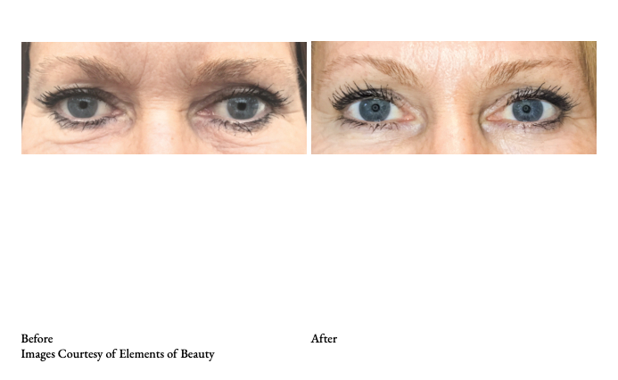 Subnovii Plasma Pen Under Eye Skin Tightening Sacramento