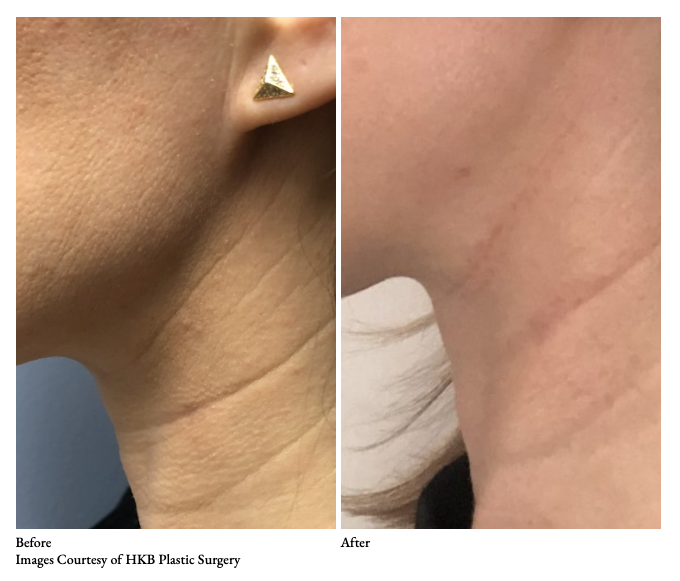 Subnovii Plasma Pen Neck Skin Tightening Sacramento