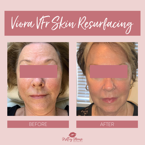 VFr Skin Resurfacing Sacramento before-and-afters