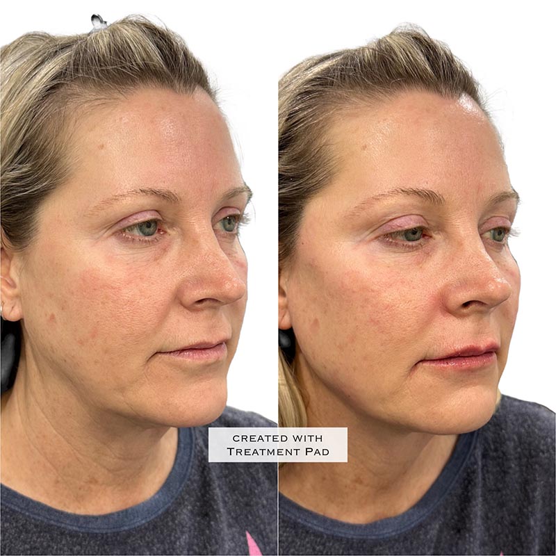 Biostimulators Before & After Image