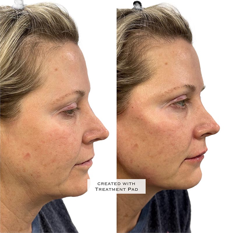 Biostimulators Before & After Image