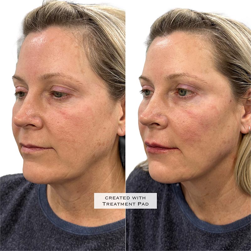 Biostimulators Before & After Image