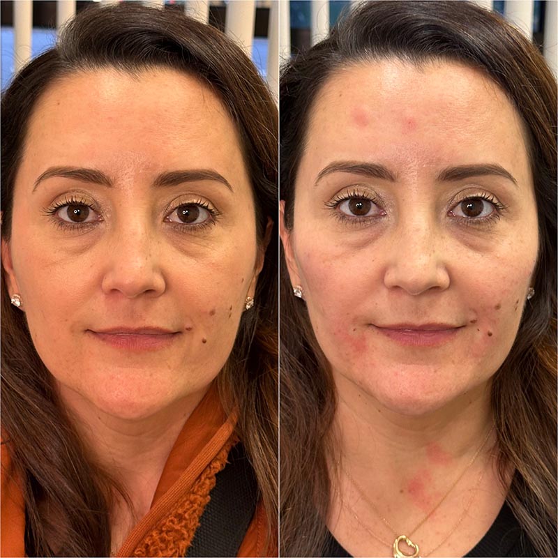 Biostimulators Before & After Image