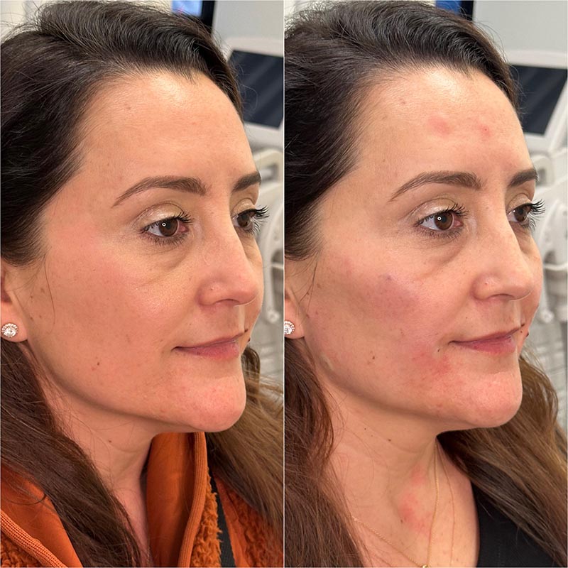 Biostimulators Before & After Image
