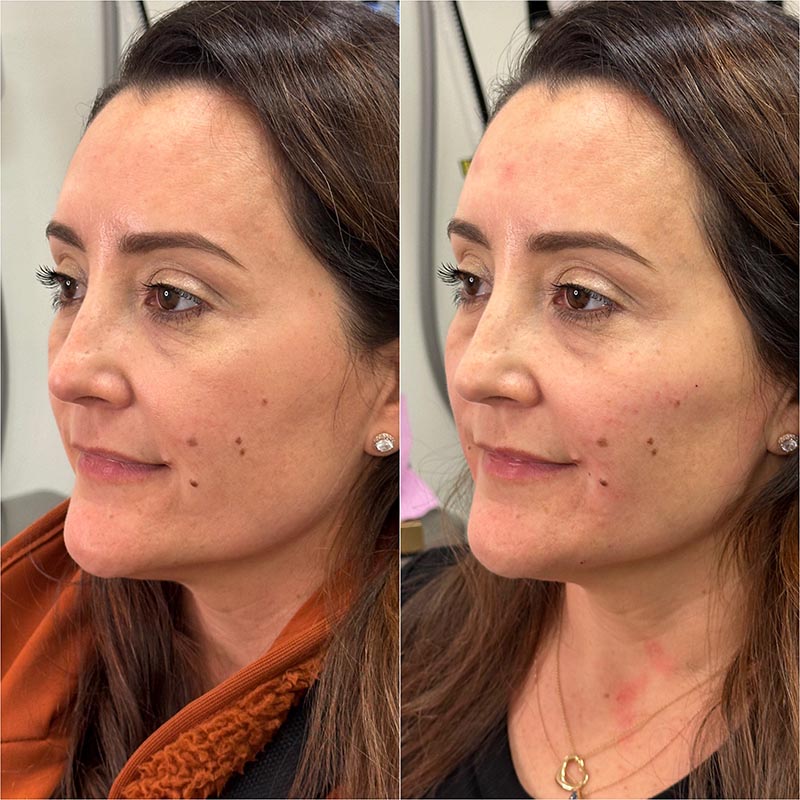Biostimulators Before & After Image