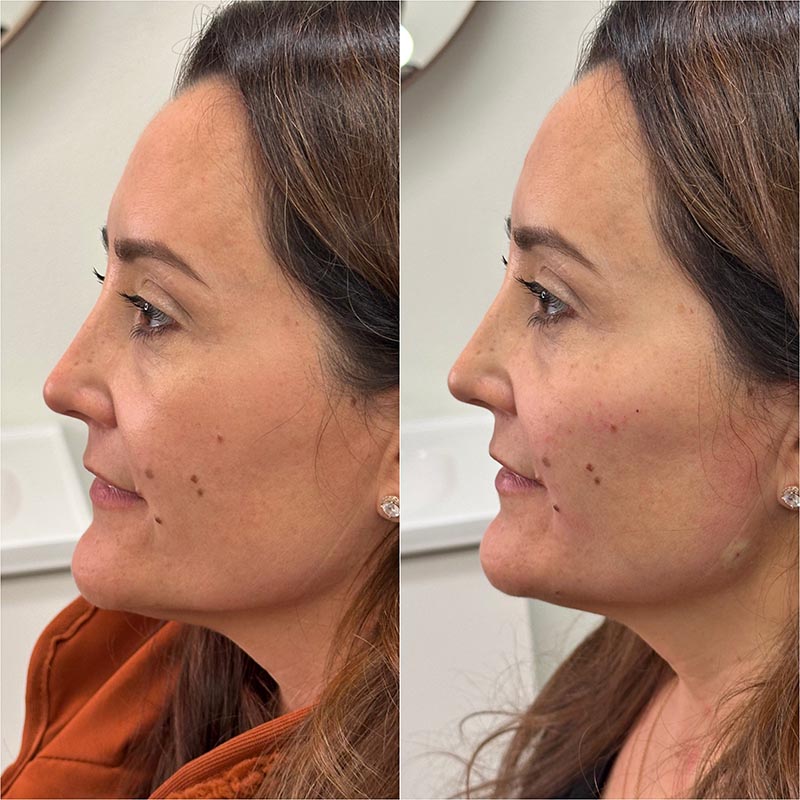 Biostimulators Before & After Image