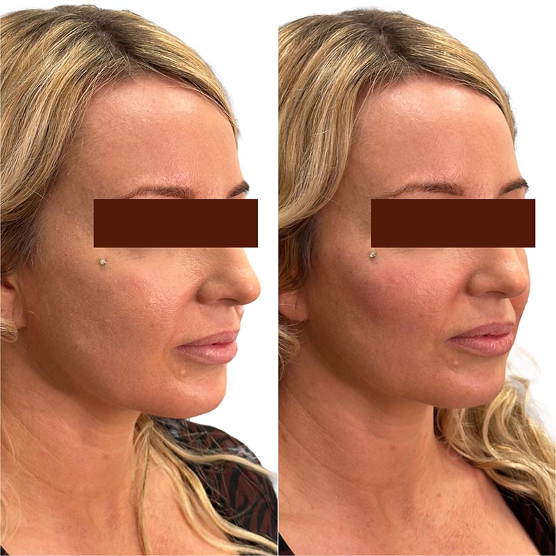 Biostimulators Before & After Image