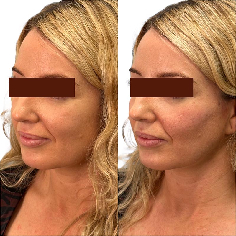 Biostimulators Before & After Image