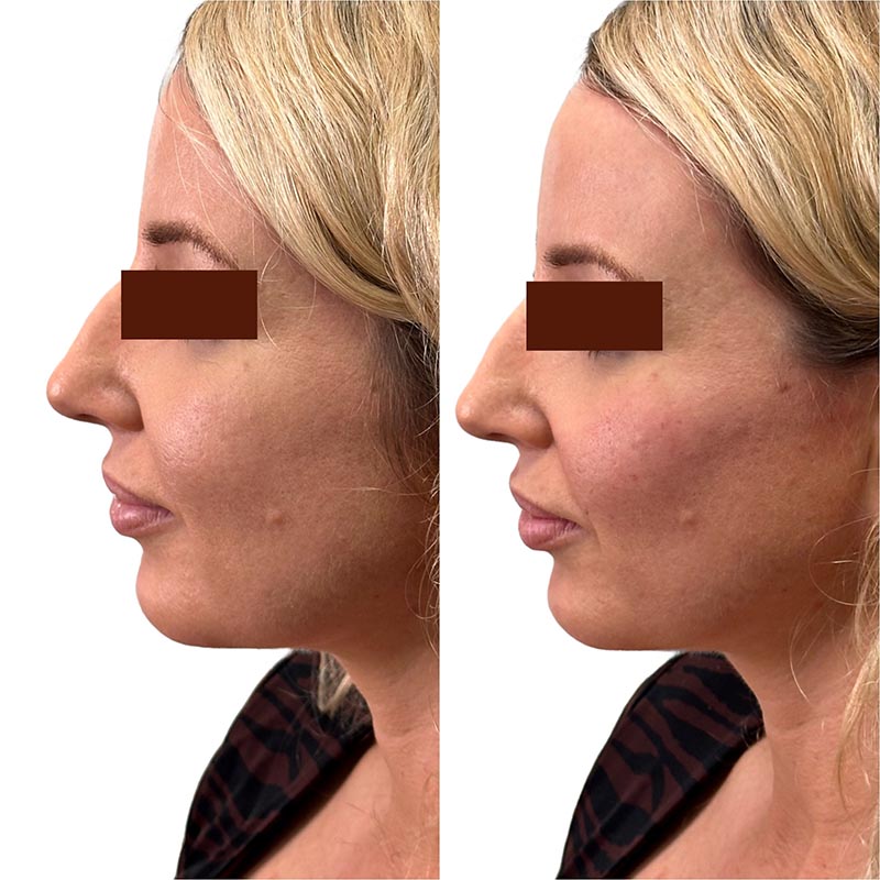 Biostimulators Before & After Image
