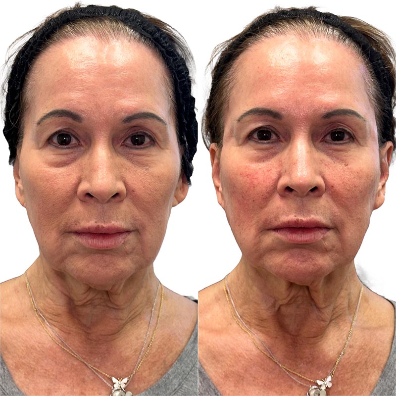 Biostimulators Before & After Image