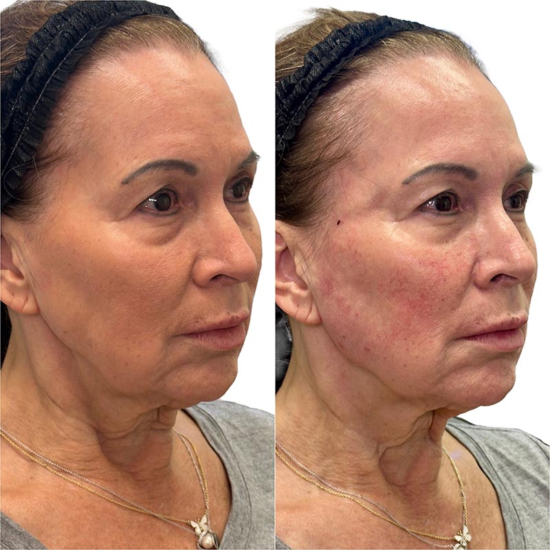 Biostimulators Before & After Image