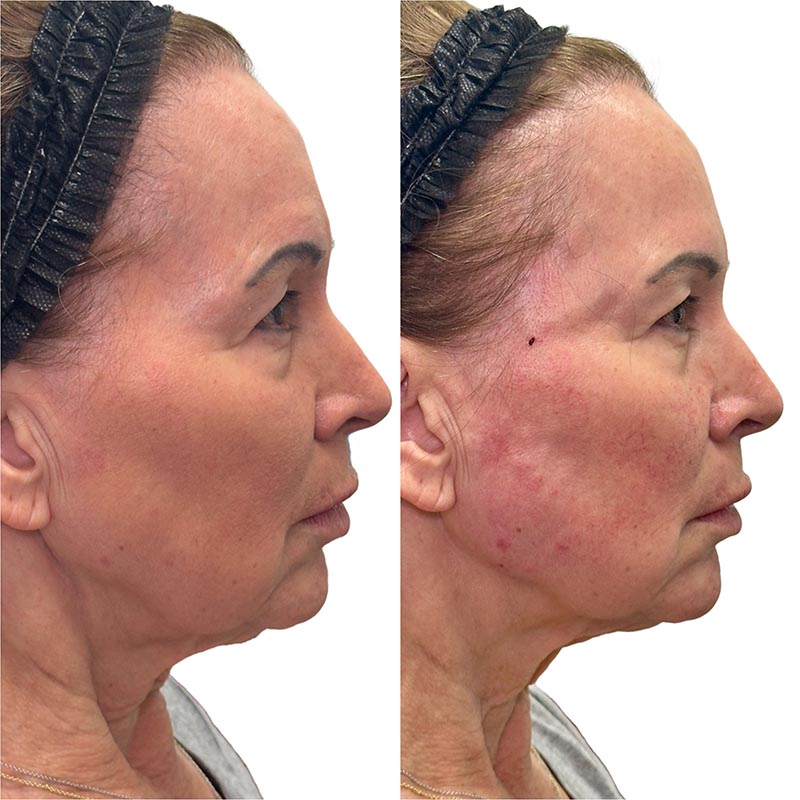 Biostimulators Before & After Image