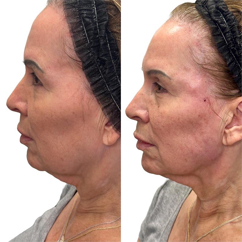 Biostimulators Before & After Image