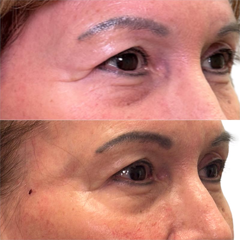 Biostimulators Before & After Image