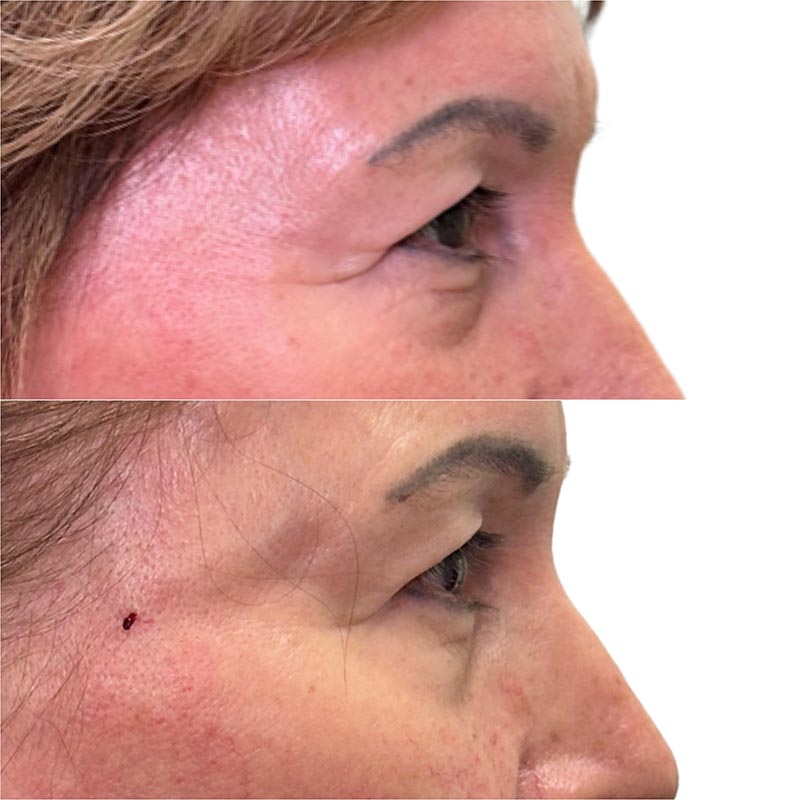 Biostimulators Before & After Image