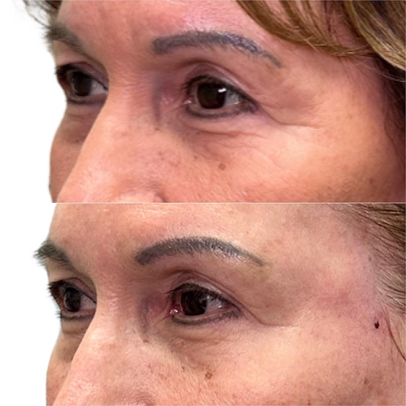 Biostimulators Before & After Image