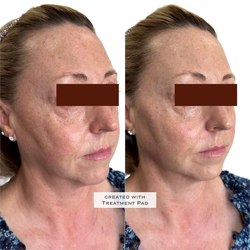 Biostimulators Before & After Image