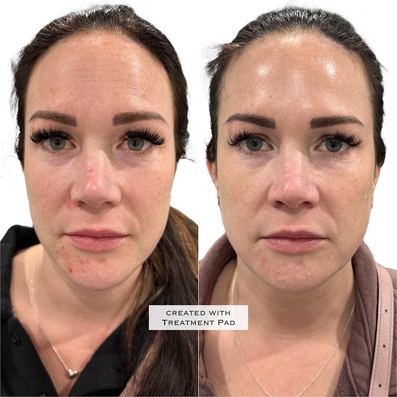Botox Before & After Image