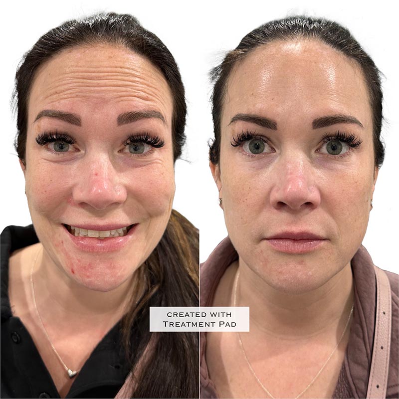 Botox Before & After Image