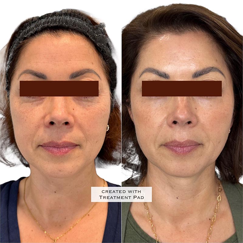 Botox Before & After Image