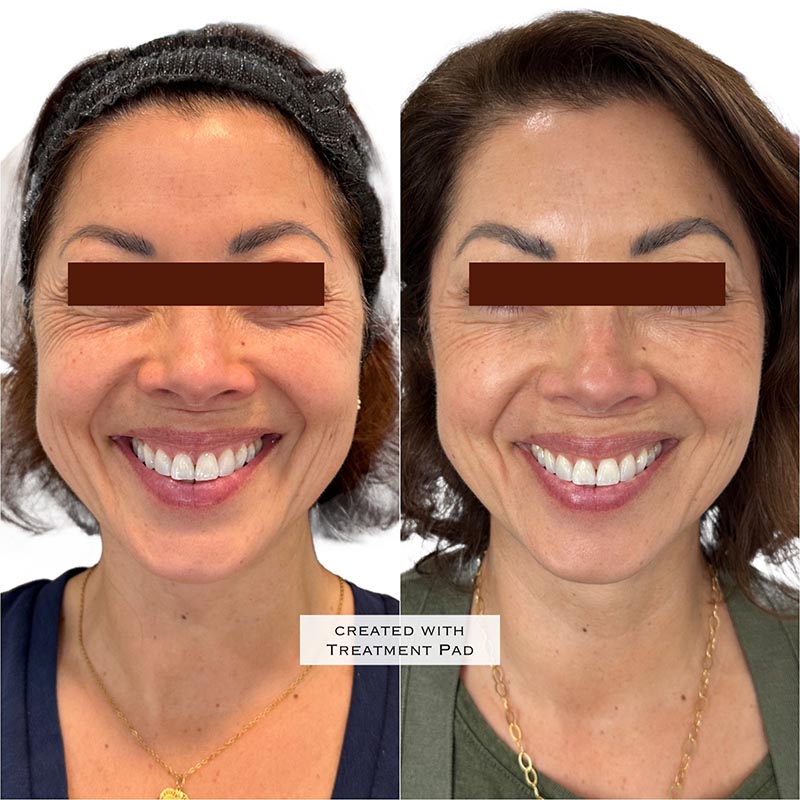 Botox Before & After Image